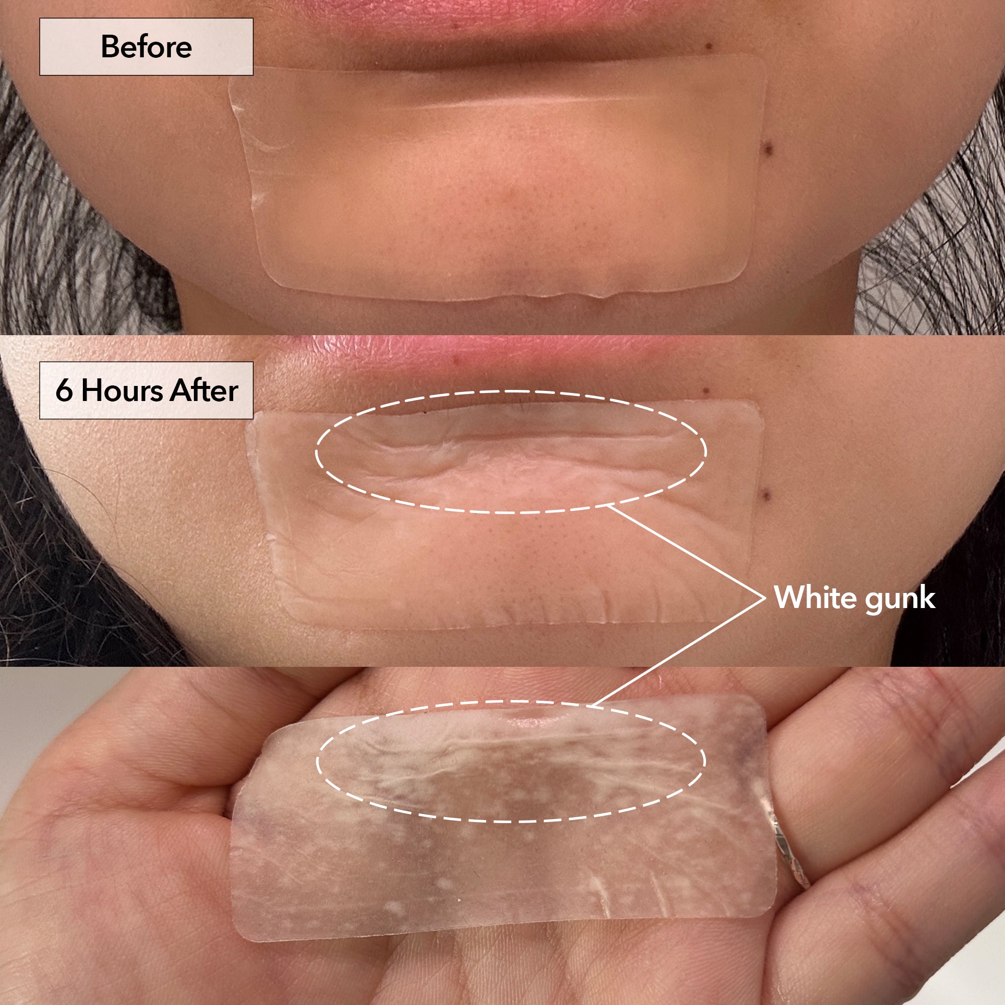 Surface+ Hydrocolloid Pimple & Pore Patch (10 Counts)