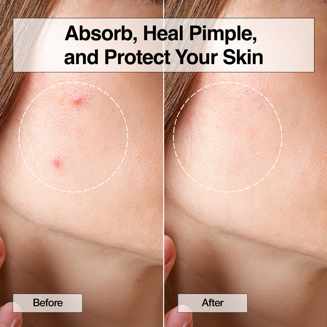 XOXO Hydrocolloid Pimple Patch (120 Counts)