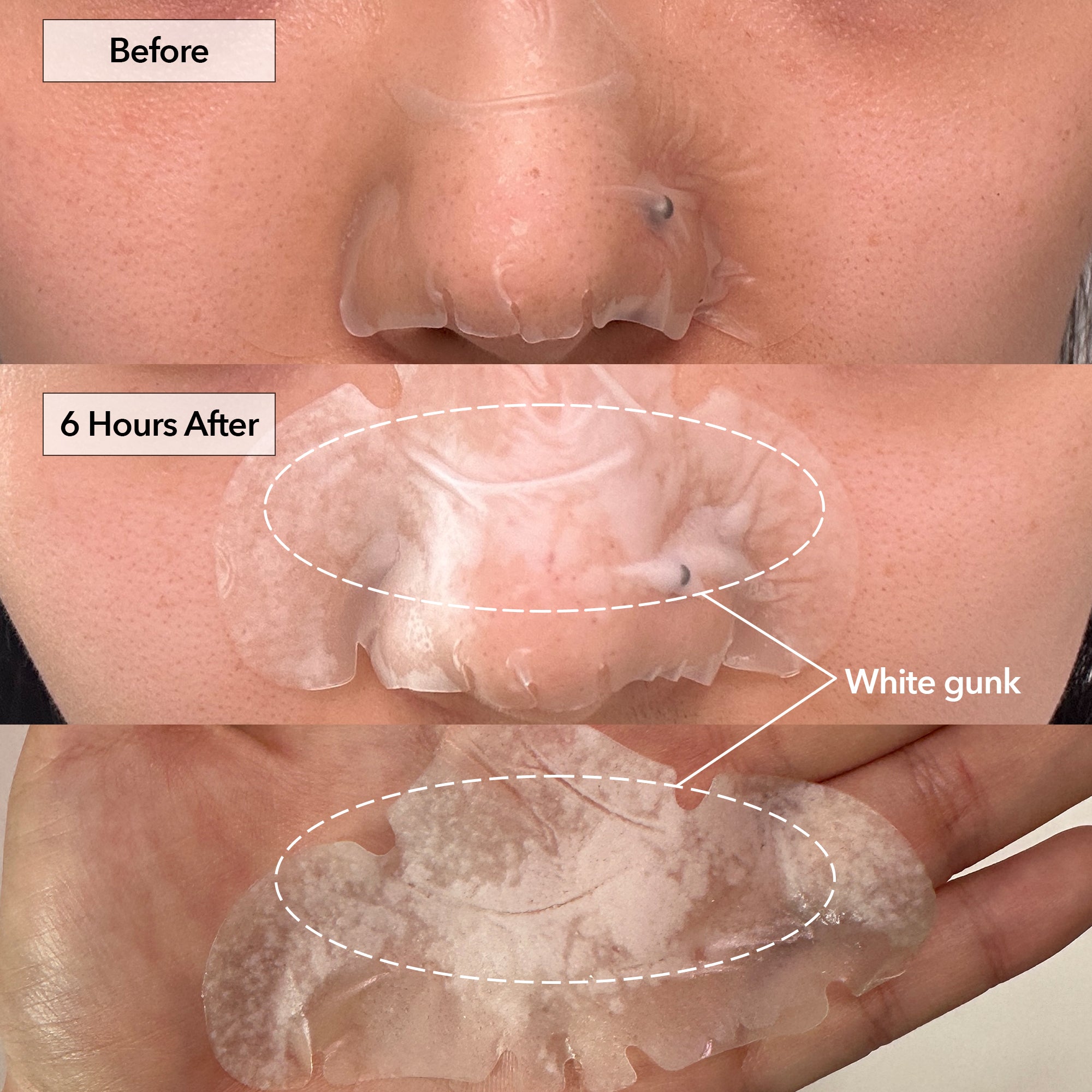 Nose+ Hydrocolloid Pimple & Pore Patch (10 Counts)