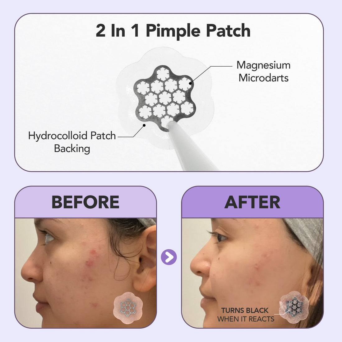 Medium Size Magnesium+ Microdarts Pimple Patch (8 Counts)