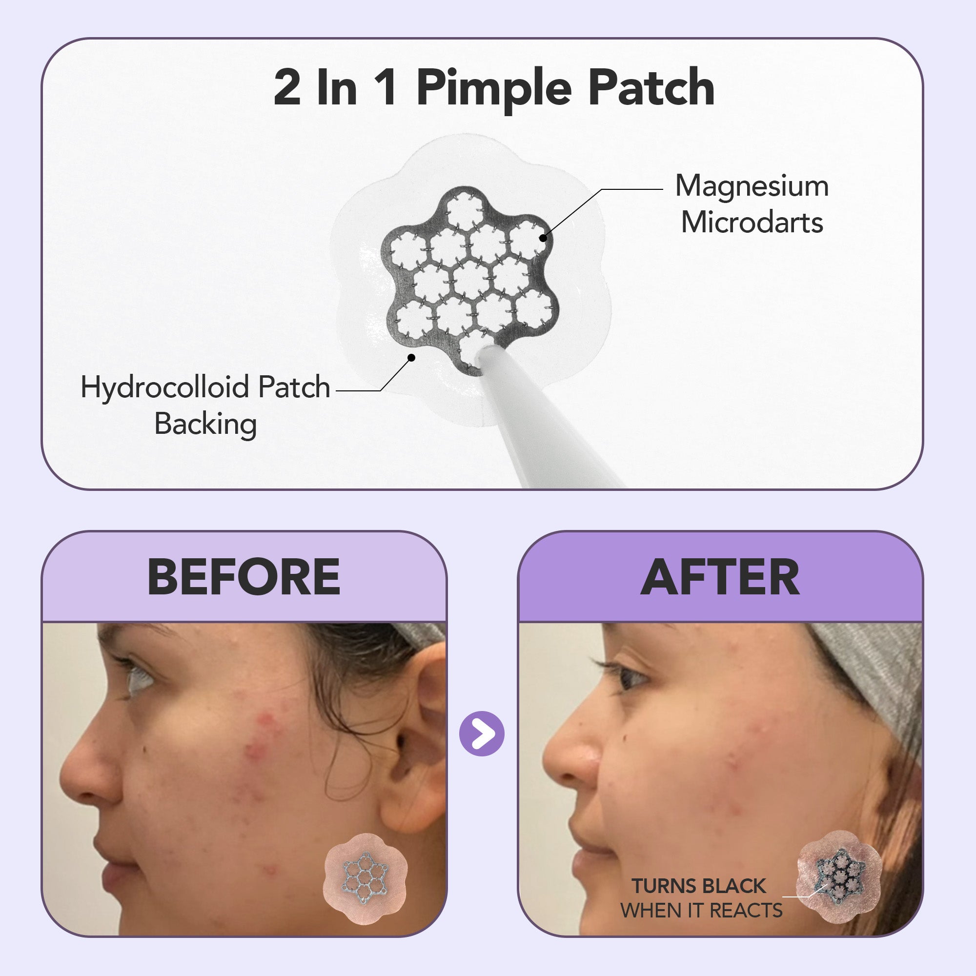 Magnesium+ Microdarts Pimple Patch (Mini) 2 Pack Bundle